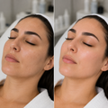 Mesoterapia con Pink Glow - 3 Sesiones - Piel Radiante y Renovada
